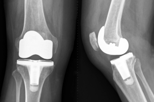 Comparison diagram showing partial knee replacement versus total knee replacement implant placement in knee joint