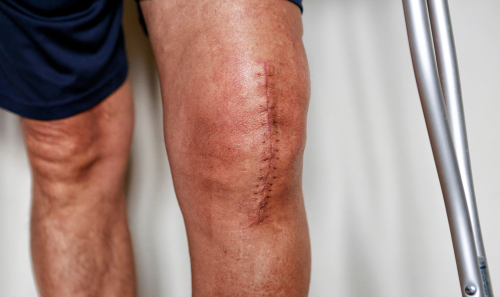 Failed Knee Replacement in Chandigarh